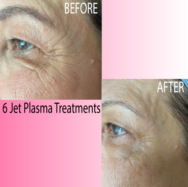 jet-plasma-before-after-skin-renewal-looking-younger-pretoria-skin-specialist-pretoria